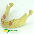 IMPLANT08 (12619) Oral Implant Dental Training Modell für fehlende Zahnimplantate